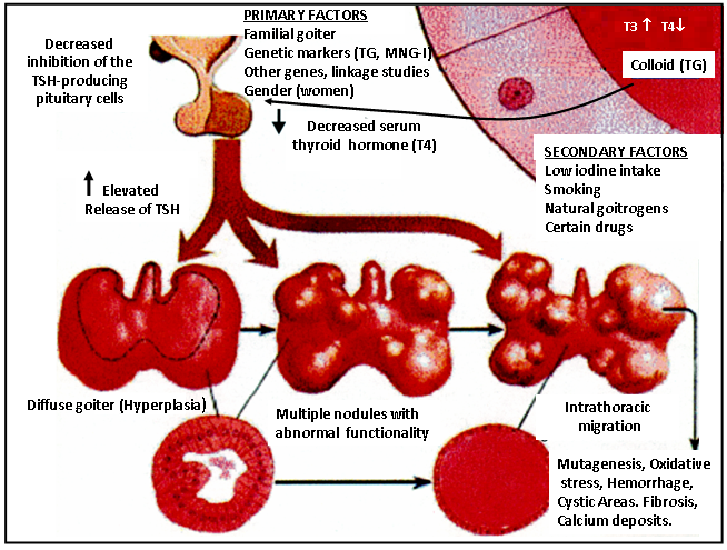 Figure 17-3: Mild iodine deficiency associated or not with smoking, presence of natural goitrogenic, drugs, familial goiter, genetic markers and gender (women) will decrease the inhibition of serum T4 on the pituitary thyrotrophs. Increased TSH production will cause Diffuse goiter followed by nodule formation. Finally, after decades of life, a large multinodular goiter is present with cystic areas, hemorrhage, fibrosis and calcium deposits.