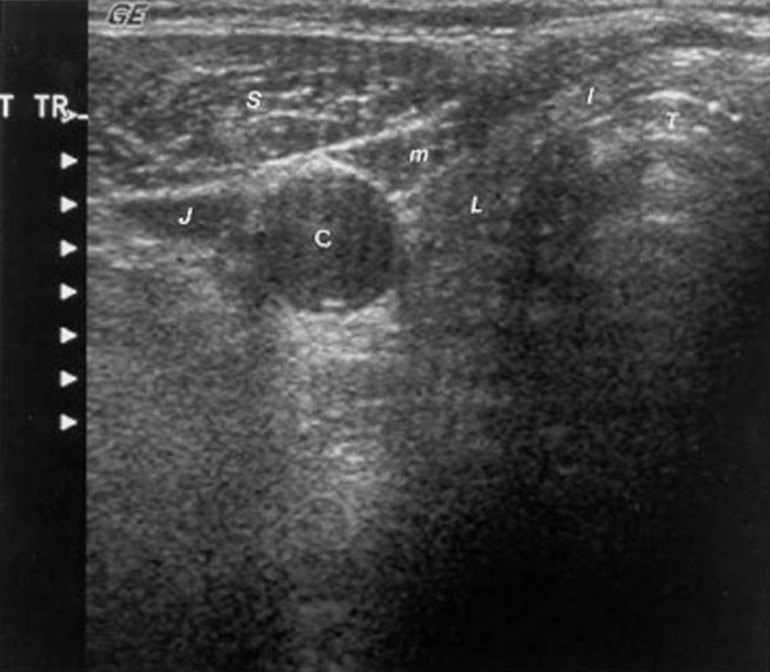 What size would a thyroid nodule need to be to cause concern?