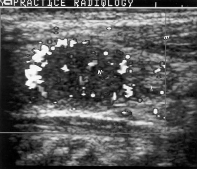 What percentage of cystic nodules on a thyroid gland turn to cancer?