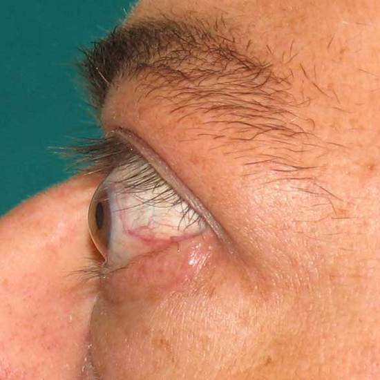 Upper Eyelid Disease
