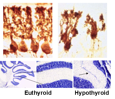 Fig 1.-Postnatal morphological changes in the rodent cerebellum after neonatal hypothyroidism. Upper panel: Purkinje cells in a normal (left) and hypothyroid rat (right). Lower panel: persistence of the external granular layer (arrow) in a hypothyroid mouse cerebellum.