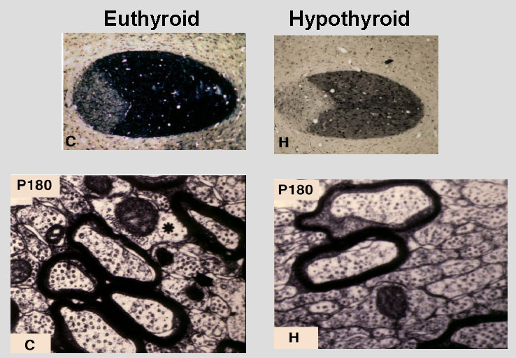 Fig 3.-Myelination in the anterior commisure of euthyroid and hypothyroid rats. Hypothyroidism was produced during the neonatal period, and the rats were analyzed at 6 months of age. He aupper panels show transversal section of the anterior commisure stained for myelin. The lower panels show electro microscopy analysis. The number of myelinated axons is reduced in the hypothyroid rats in parallel to an increased number of small diameter axons. Those axons reaching a critical size have near normal myelin content, but still present structural defects (From (49)).