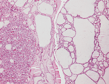 What size would a thyroid nodule need to be to cause concern?