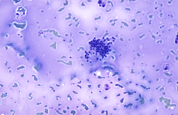 What percentage of cystic nodules on a thyroid gland turn to cancer?