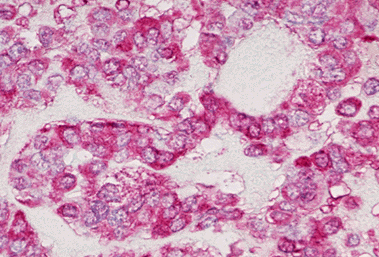 Thyroid Medullary Carcinoma