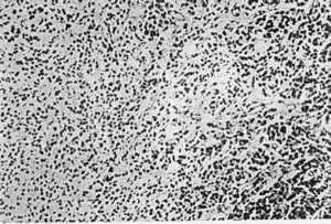 showing intense hyperplasia with no colloid