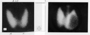 Scan of nodule