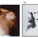 etx-lipidpeds-ch17-fig8