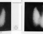 Scan of nodule